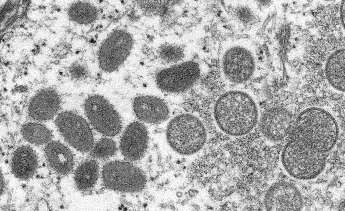 As can be seen with the 2003 Monkeypox outbreak in prairie dogs, a clinical sample of human skin is seen with an electron microscopic image of the particles of the Monkeypox virus. The WDPH was sent 104 reports of potential human MPXV cases. 27 of the 104 cases were mostly confirmed (70%), and some were only suspected, according to the  National Library of Medicine. 